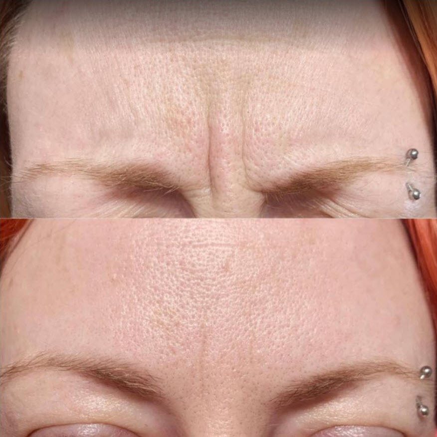 Calgary botox for forehead elevens frown lines.jpg